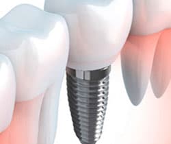Implante Dentário